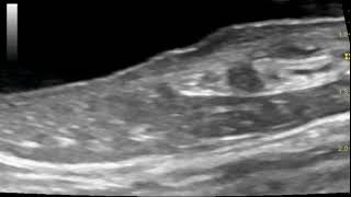 Sonography of distal ureter ureteral papilla and ureteral jet in a dog with pyelonephritis [upl. by Ssegrub]