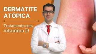 Tratamento de dermatite atopica com vitamina D [upl. by Suez300]