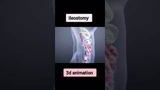 Ileostomy surgery 3d shorts medical humanbody 3danimation treatment anatomy surgery [upl. by Nayd]