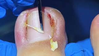 Satisfying Ingrown Toenail Removal [upl. by Longawa]