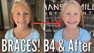 Shes Getting Braces  8 Year Old Goes to the Orthodontist to Get Braces Put On [upl. by Adriane590]