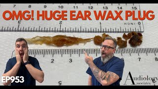 OMG HUGE EAR WAX PLUG REMOVED  EP953 [upl. by Shayn]