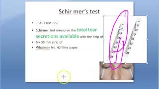 Ophthalmology 396 b Schirmer test Dry eye Tear Film test Paper Keratoconjunctivitis Sicca KCS [upl. by Rosenblum628]