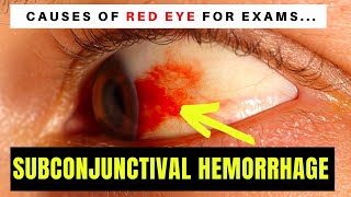 Causes of Red Eye  Part 1 SUBCONJUNCTIVAL HAEMORRHAGE blood on the eyeball [upl. by Nesahc437]