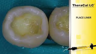 Technique de restauration directe TheraCal LC  AllBond Universal  Aelite [upl. by Averir944]