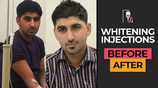 BeforeAfter Full Body Whitening Transformation in Karachi Pakistan  Glutathione Injection Results [upl. by Lekzehcey]