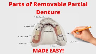 Parts of Removable Partial Denture Cast Partial Denture [upl. by Kano]