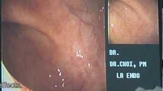 1 Minute Colonoscopy  Los Angeles Colonscopy [upl. by Incrocci148]