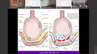 Update in management of ARDS [upl. by Sivartal]