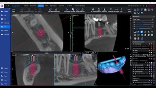 Modulo Implant Guide [upl. by Eedolem304]