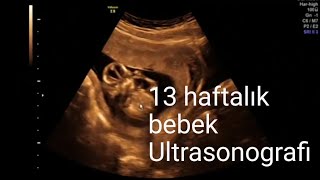 13 haftalık gebelikte ultrasonografi  bebeğin organları plasenta ve amniyos sıvısı [upl. by Odnomra]