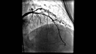 Acute anterior wall myocardial infarction [upl. by Nalyad]