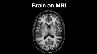 Anatomy of the Brain on MRI [upl. by Pasia]