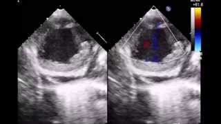 Anterior Wall Myocardial Infarction Complicated by a Very Large Ventricular Septal Rupture and Card [upl. by Eniale526]