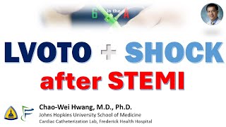 Cardiogenic Shock from LVOT obstruction postMI [upl. by Ceevah]