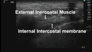 Ultrasound guided Thoracic paravertebral block with a HFL50 probe [upl. by Assirec747]