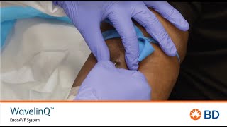 BD WavelinQ™ EndoAVF Cannulation Quick Training with patient [upl. by Adrien]