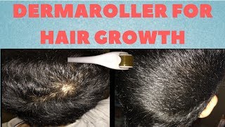 How To Regrow Hair With A Dermaroller Properly [upl. by Merl]