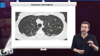 Doença Pulmonar Obstrutiva Crônica DPOC  Aula de Pneumologia SanarFlix [upl. by Rye]