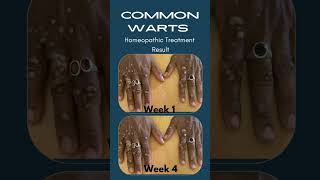 Common Warts Everything You Need to Know [upl. by Ennairak]