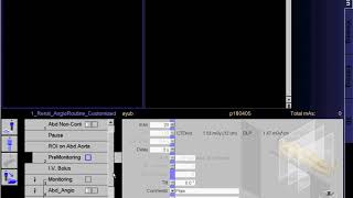 CT Renal Angio Data SIEMENS [upl. by Yznyl]