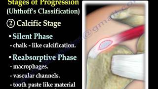 Calcific Tendonitis  Everything You Need To Know  Dr Nabil Ebraheim [upl. by Ained478]