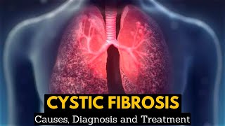 CYSTIC FIBROSIS Causes Signs and Symptoms Diagnosis and Treatment [upl. by Piero]