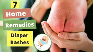 How To Treat Baby Diaper Rashes Fast At Home  7 Best Natural Home Remedies For Baby Diaper Rashes [upl. by Marwin]