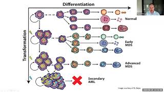 MDS  AML  2020 Spring Virtual Conference When MDS becomes AML  for HighRisk MDS Patients [upl. by Robinet998]