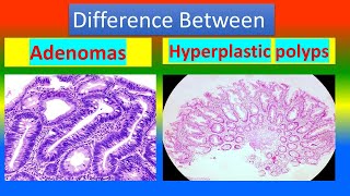 Difference between Adenomas and Hyperplastic Polyps [upl. by Africa]