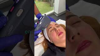 Lifting facial con Hifu aparatología de alta intensidad que trabaja en lo más profundo de tu piel🤩💙 [upl. by Server]