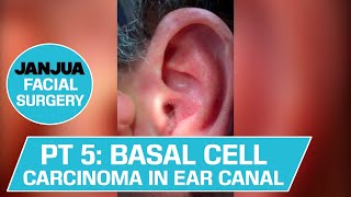 PART 5  BASAL CELL CARCINOMA IN THE EAR CANAL  DR TANVEER JANJUA  NEW JERSEY [upl. by Odlanra]