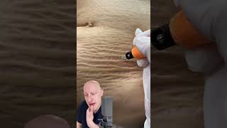 Plasma Pen As A Cure For Stretchmarks  Doctor Reacts [upl. by Orodisi764]