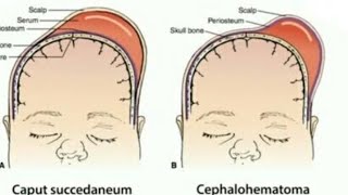 Caput succedaneum vs cephalhematoma [upl. by Lin]