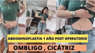 ABDOMINOPLASTIA 1 AÑO POSTCIRUGIA [upl. by Alick]