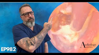 Most Satisfying Ear Wax And Thick Dead Skin Removal From Ear   EP982 [upl. by Eatnuahs666]