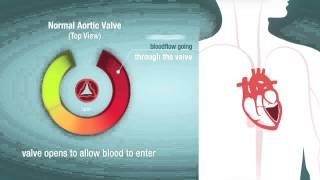 Valve Stenosis When a Heart Valve is Too Narrow [upl. by Costanza]