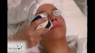 MeDioStar NeXT  Training video for hair removal face from Asclepion [upl. by Innob]