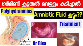 Pregnancy Complication Malayalam Polyhydramnios Amniotic fluid Normal level [upl. by Nylikcaj369]