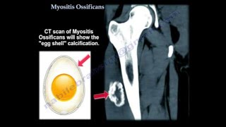 Myositis Ossificans  Everything You Need To Know  Dr Nabil Ebraheim [upl. by Charmian]