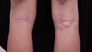 Sclerotherapy Varicose Veins Treatment [upl. by Yrrat]