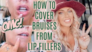 How to Cover Bruises from Lip Fillers amp My First Lip Filler Experience [upl. by Reichert]