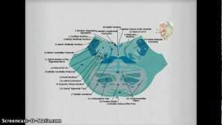 Medial Inferior Pontine Syndrome pics [upl. by Gainor]