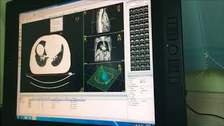 Radiotherapy Treatment Planning Breast Cancer [upl. by Ynnaf]