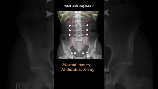 Normal bones  Abdominal Xray 10 Abdominal Xray  System and anatomy radiologychannel007 [upl. by Yecal361]