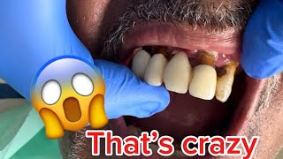 Crwons and teeth removing 😱CRAZY video 🤢🤢 [upl. by Nosac]