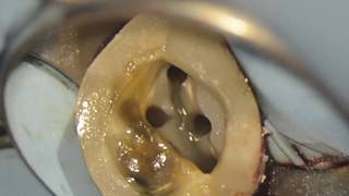 Traitement endodontique sous microscope 4 canaux  27 [upl. by Blen]