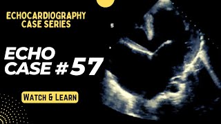 Echo Case 57 Echocardiography Spot Diagnosis Series  Cardiology  Educational Video [upl. by Gerti]