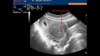 gravidanza alla 5° settimana di gestazione e fibroma uterino [upl. by Adnilym]