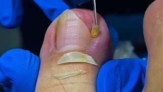 Remove Huge Ingrown Toenail in 5 Minutes with PROPER Trimming [upl. by Akirat759]